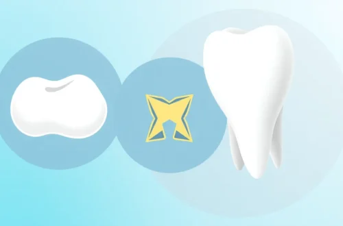 충치 치료 레진, 인레이, 크라운 차이점 및 비용 비교 16 example 205