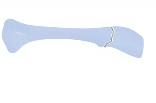 뼈 부상 신호: 타박상과 금 간 뼈 구별법 8 example 13